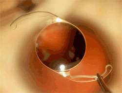 Intraocular lens (IOL) implant