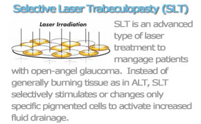 Selective laser Trabeculopasty (SLT)