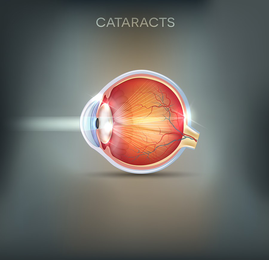 Split View of human Eye with Cataracts